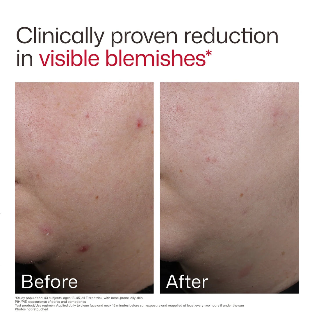 EltaMD - UV Clear Blemish-Prone &amp; Oil Balancing SPF 50