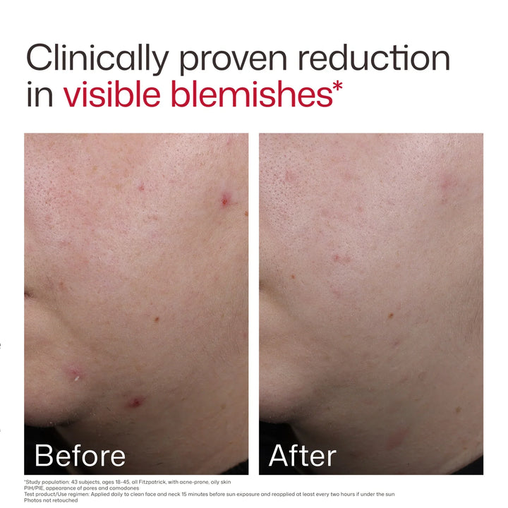EltaMD - UV Clear Blemish-Prone &amp; Oil Balancing SPF 50