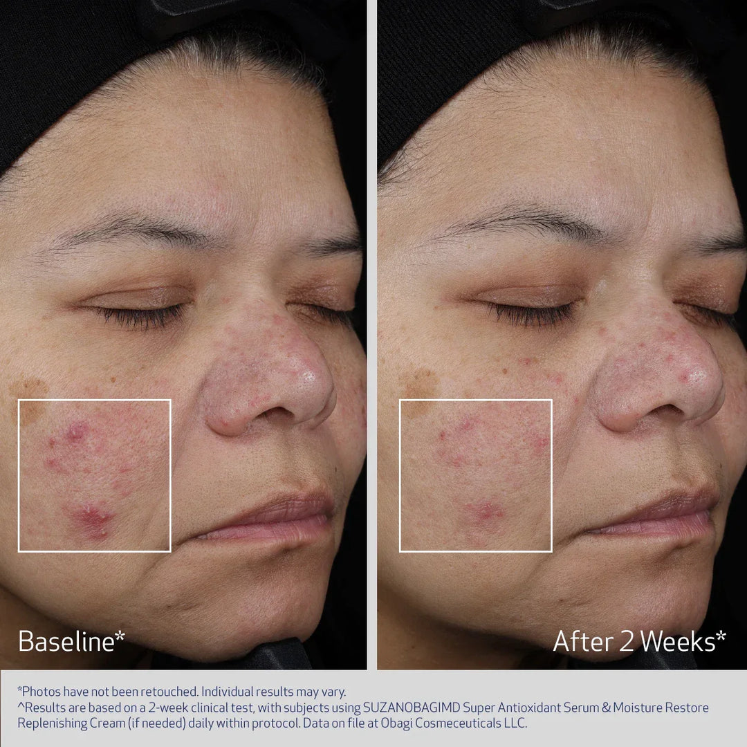 Obagi - SUZANOBAGIMD® SUPER ANTIOXIDANT SERUM