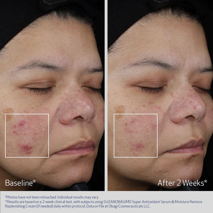 Obagi - SUZANOBAGIMD® SUPER ANTIOXIDANT SERUM
