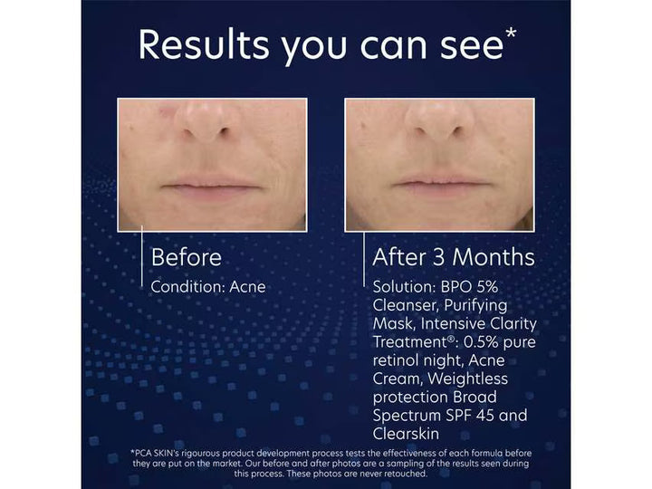 PCA Skin - BPO 5% Cleanser