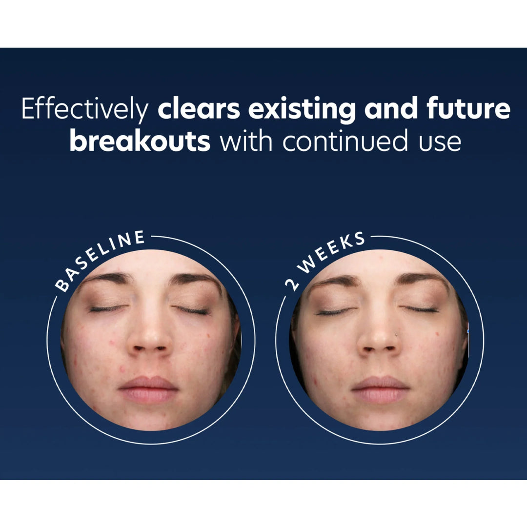 PCA Skin - Acne Gel
