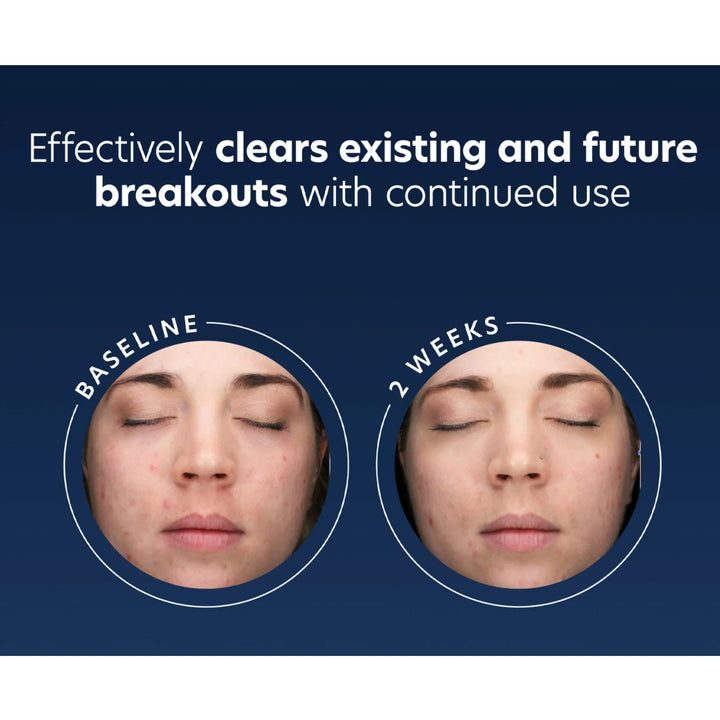 PCA Skin - Acne Gel