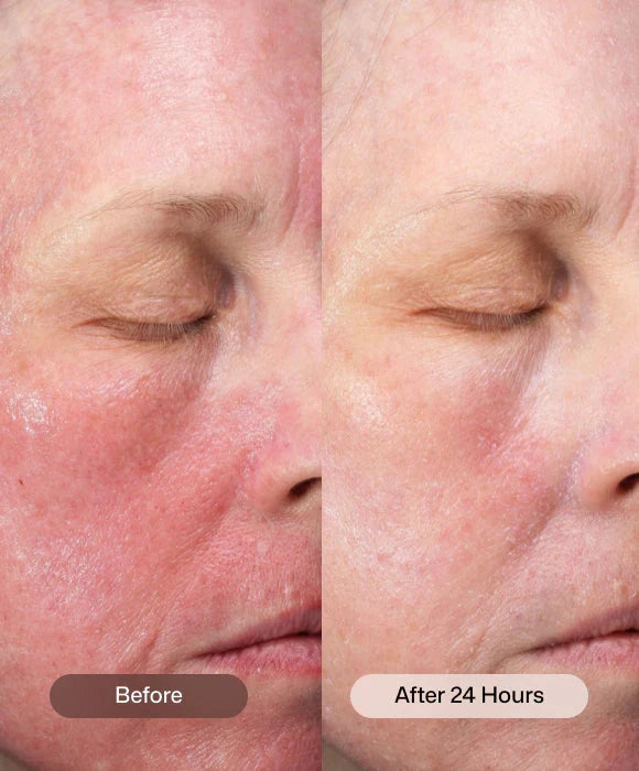 Revision - CMT Post-Procedure Cream